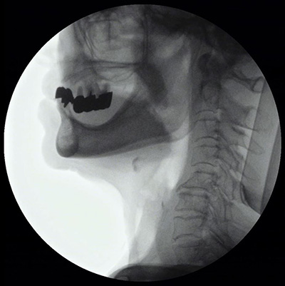 嚥下造影検査(VF)